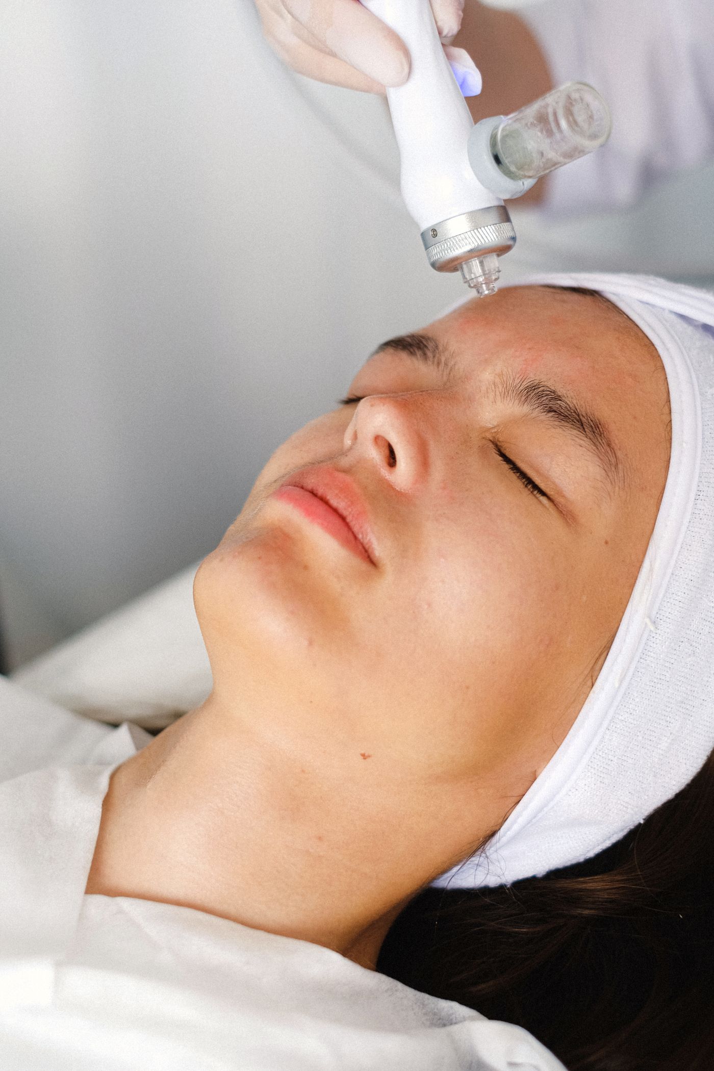 Chemische peeling behandeling